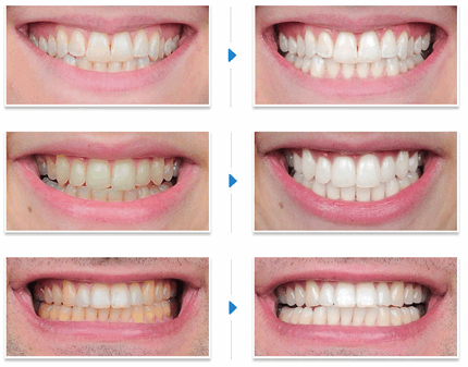 Infrared Therapy for mouth